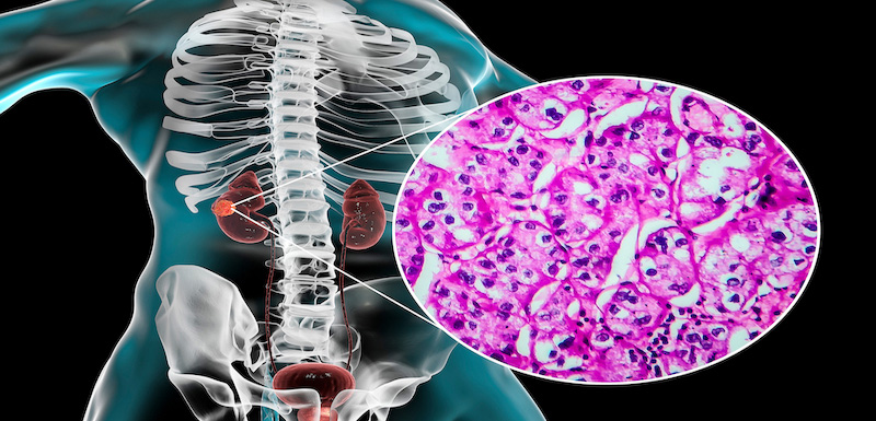 Advanced Renal Cell Carcinoma: Making the Most of Immunotherapies and Targeted Agents